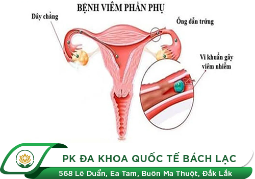 Viêm phần phụ