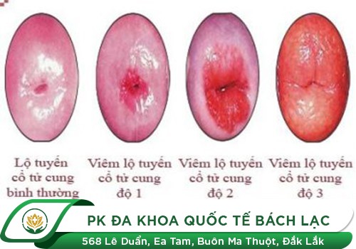 Viêm Lộ Tuyến Độ 1 Có Cần Thiết Phải Điều Trị Không