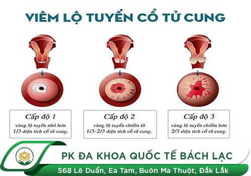 Viêm Lộ Tuyến Độ 3 Và Mức Độ Nguy Hiểm Khó Lường