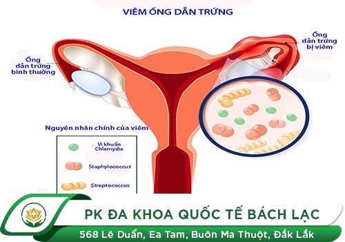 Những Triệu Chứng Thường Gặp Của Bệnh Viêm Ống Dẫn Trứng