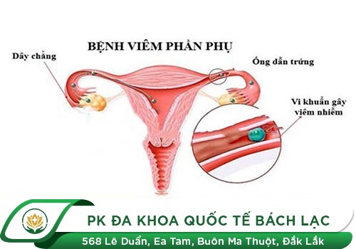 viêm phần phụ