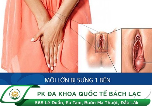 Sưng Mép Vùng Kín Ở Nữ Giới Khiến Bạn Khó Chịu