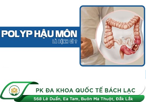 Polyp hậu môn là bệnh gì? Có nguy hiểm hay không?