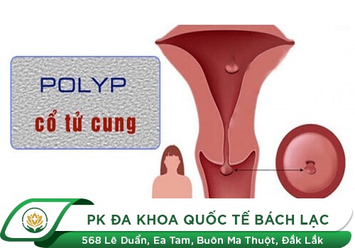 Polyp cổ tử cung ở nữ giới là bệnh gì