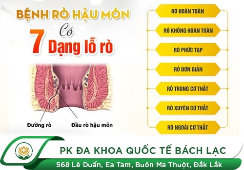 NHỮNG DẠNG RÒ HẬU MÔN NÊN BIẾT