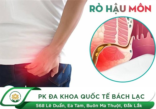 Rò hậu môn là gì?
