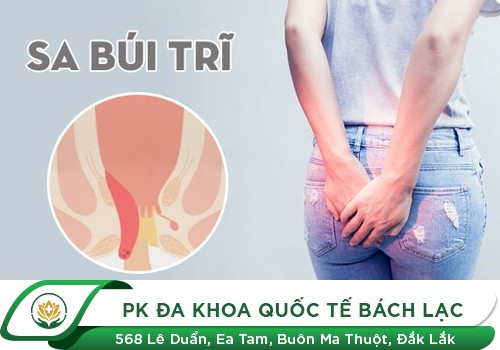 Sa búi trĩ là bệnh gì?