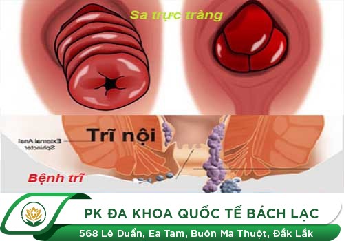 Điều Trị Sa Trực Tràng Như Thế Nào Hiệu Quả