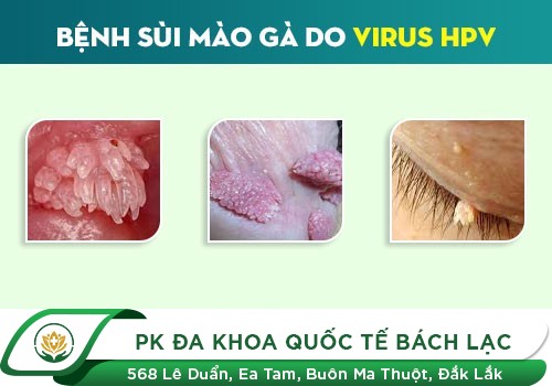Hình ảnh bệnh sùi mào gà