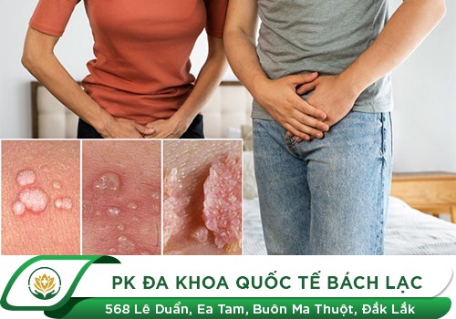Triệu Chứng Sùi Mào Gà Ở Nữ Cần Lưu Ý