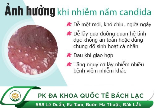 Tổng quan về bệnh nấm phụ khoa ở nữ giới
