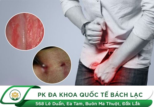 Đầu Khấc Bao Quy Đầu Bị Nổi Mẩn Đỏ