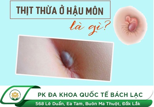 Nổi Thịt Thừa Ở Hậu Môn Là Bệnh Gì