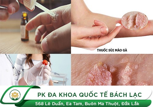 Điều Trị Sùi Mào Gà Bằng Acid Trichloracetic Có Thật Sự Tốt Không