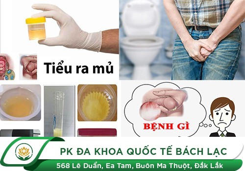 Chớ Xem Thường Tình Trạng Tiểu Ra Mủ