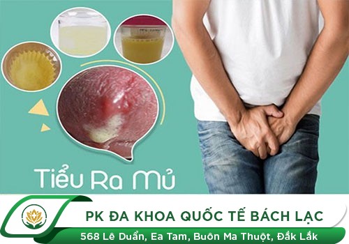 Tiểu Ra Dịch Nhầy Có Phải Bị Bệnh Lậu Không