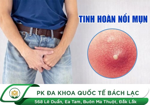 Tinh hoàn nổi mụn là biểu hiện của bệnh gì?