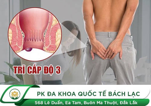 Trĩ cấp độ 3 là như thế nào?