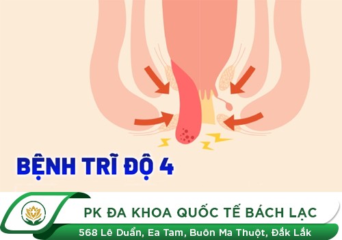 Trĩ cấp độ 4 là như thế nào?