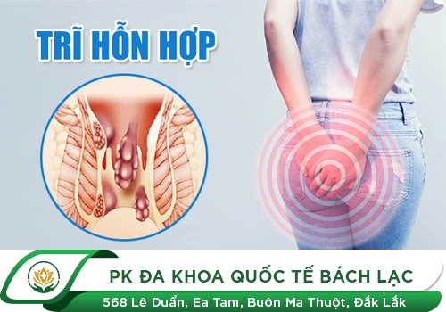 Trĩ hỗn hợp là gì?