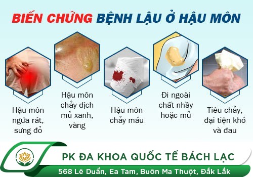 Bệnh Lậu Ở Hậu Môn: Nguyên Nhân, Triệu Chứng Và Phương Pháp Điều Trị Hiệu Quả