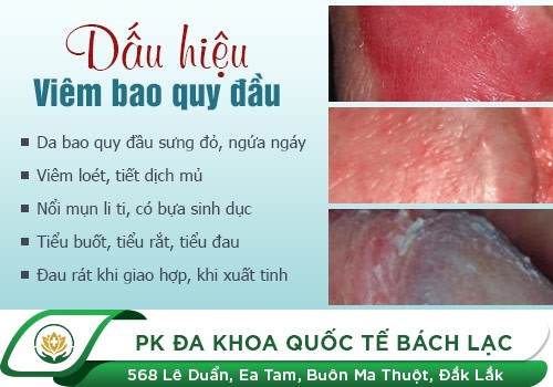 Nứt Bao Quy Đầu – Nguyên Nhân Và Cách Chữa Trị Hiệu Quả