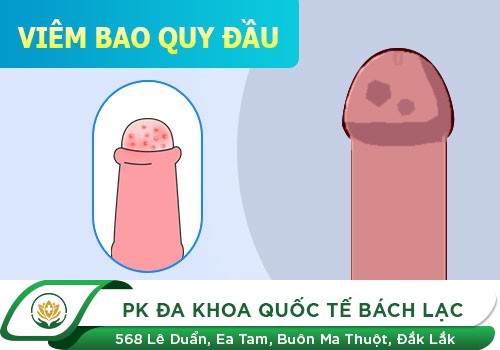 2 Phương Pháp Điều Trị Viêm Bao Quy Đầu Tốt Nhất Hiện Nay