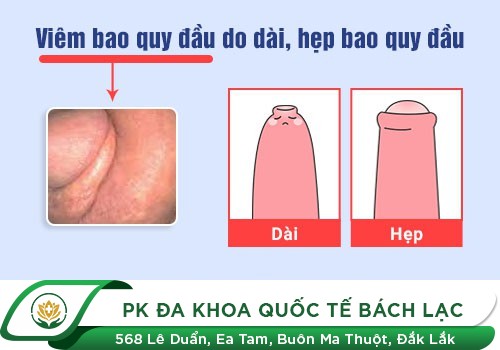 Nguyên nhân gì khiến bạn bị hẹp bao qui đầu