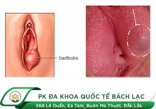 Viêm tuyến Bartholin là gì?