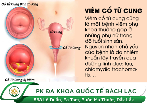 Thuốc trị viêm cổ tử cung hiệu quả cho chị em