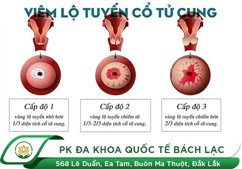 Tìm hiểu về bệnh viêm lộ tuyến cổ tử cung diện rộng