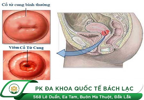 Viêm cổ tử cung và các triệu chứng thường gặp