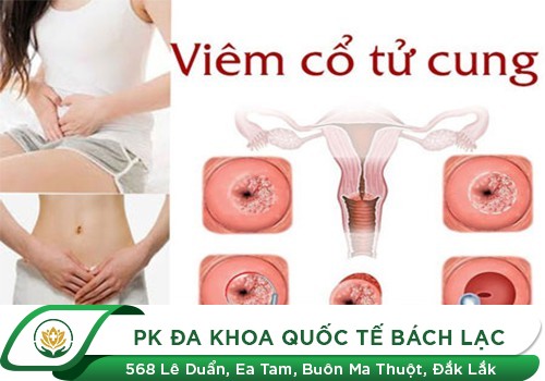 Nguy hiểm khó lường từ viêm cổ tử cung