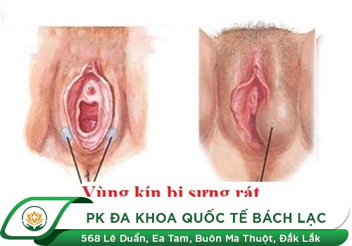 Sưng Vùng Kín Sau Quan Hệ Là Bị Gì